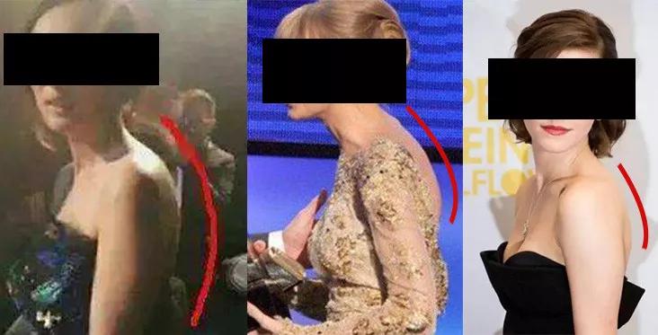 脖子前傾導致形體不佳,氣質大打折扣